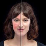 Rosacea,Before,And,After,Laser,Treatment.,Successful TrendRehab